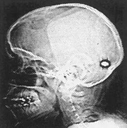 X-ray of the bullet inside Nicola's head.